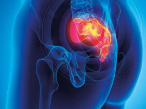 Κύστη κόκκυγος