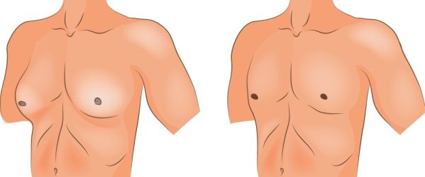 gynaikomastia2 gynaikomastia2