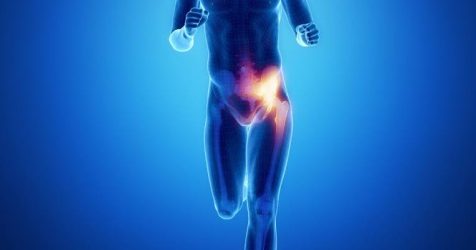 Κήλη Αθλητών, Sports Hernia, Σύνδρομο Κοιλιακών ροσαγωγών