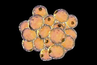 lipoma1 lipoma1