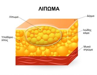 lipoma2 lipoma2